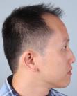 Before Hair Transplant&nbsp;Front
